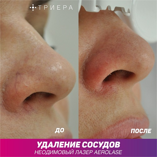 лечение купероза удаление сосудов на лице лазером