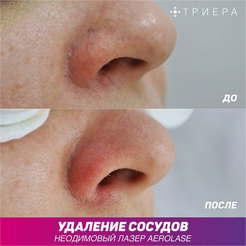 лечение купероза удаление сосудов на лице лазером